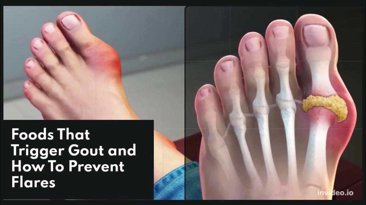 Foods That Reduce Uric Acid In The Body, 15 Foods That Trigger Gout And