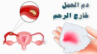 متى ينزل دم الحمل خارج الرحم ؟