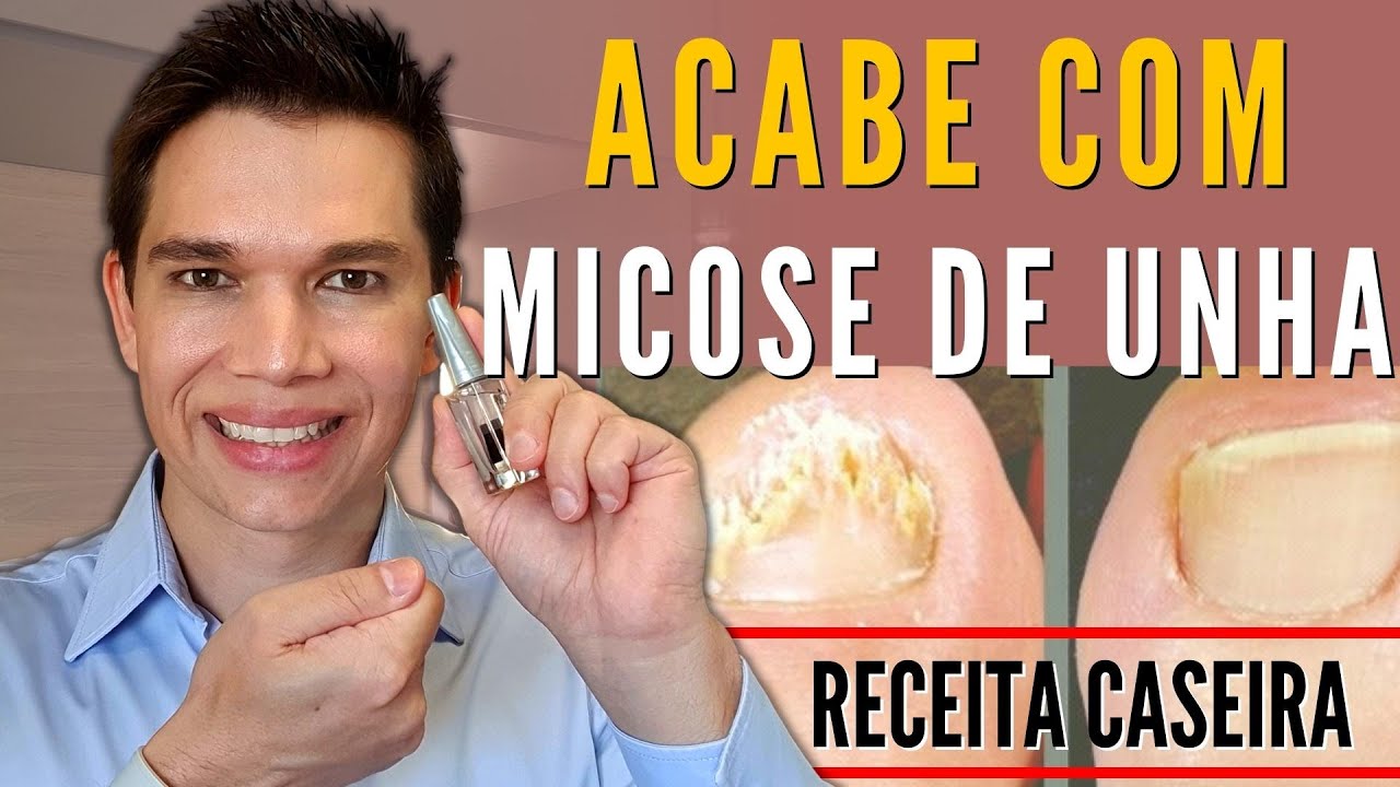 ACABE com a MICOSE DE UNHA - 3 tratamentos CASEIROS!