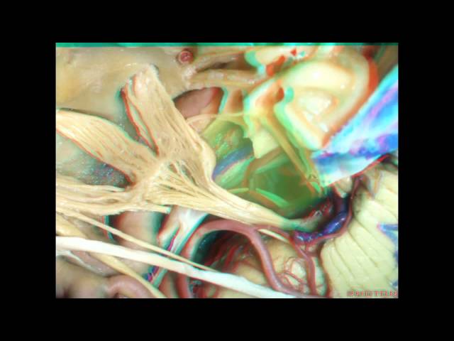 Cavernous Sinus and Middle Fossa (3D) - Part 2 of 2