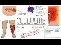 Understanding Cellulitis: Skin and Soft Tissue Infections