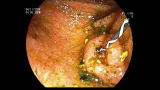 "ERCP WITHOUT FLUOROSCOPY IN 27WK IVF TRIPLET PREGNANT LADY"