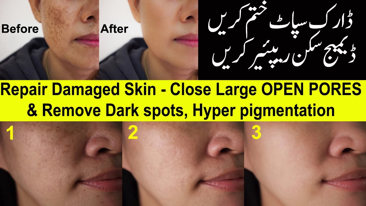 How to remove dark spots | Remove pigmentation at home | Remove acne ...