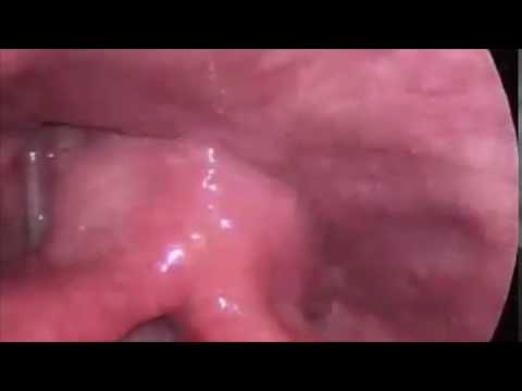 Edema cuerdas vocales operacion