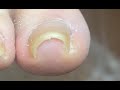 Super curvy nail treatment