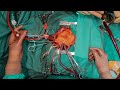 First Person Heart Surgery: From Skin Incision to Heart Arrest