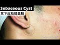 耳下皮脂腺囊腫( sebaceous cyst under ear ) - Taiwan Tainan台南清粉刺最乾淨