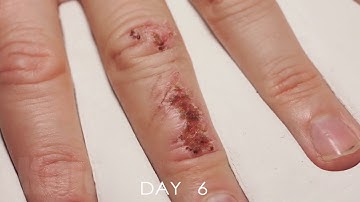 Wound Healing Time Lapse