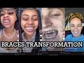 BRACES OFF TRANSFORMATION | BRACES TRANSFORMATION