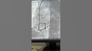 Conduction system pacing(LBB PACING)