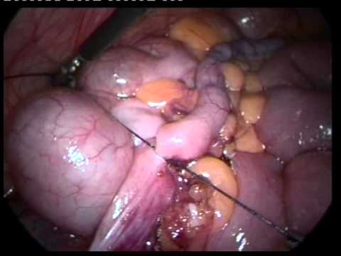 Laparoscopic Videos (edited-5)-Lap Appendectomy In Pregnancy