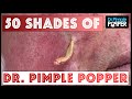 50 shades of DrPimplePopper: A 1 Million Subs Special