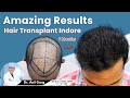 5125 graft  hair transplant in indore  best results  cost of hair transplant in indore