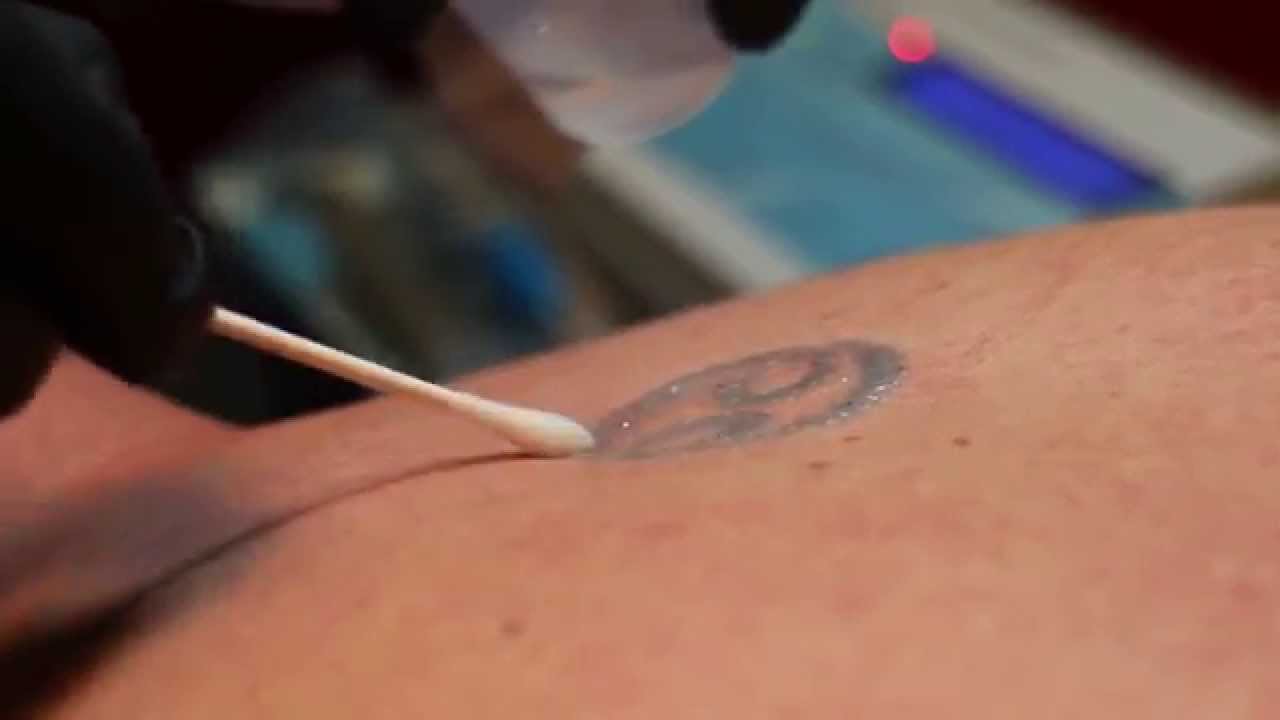 Can Microneedling Remove Tattoo