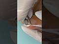 Ingrown toenail  hack diy  worked for me 