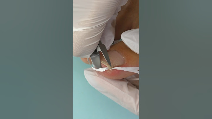 INGROWN TOENAIL 🦶 hack DIY - Worked for Me !