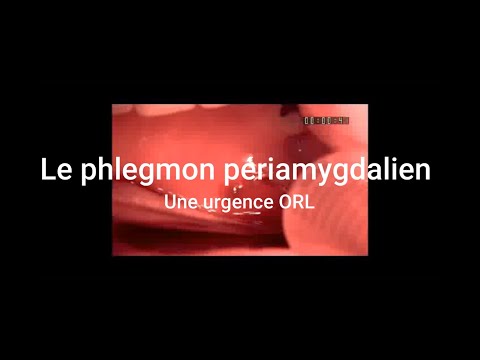 Vidéo: Est-ce que l'abcès périamygdalien disparaît ?