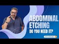 ABDOMINAL ETCHING - Do You Need It?