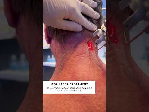 Transform Your Skin with Precision CO2 Laser Resurfacing