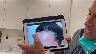 Two weeks after Hairline Lowering/Forehead Reduction Surgery