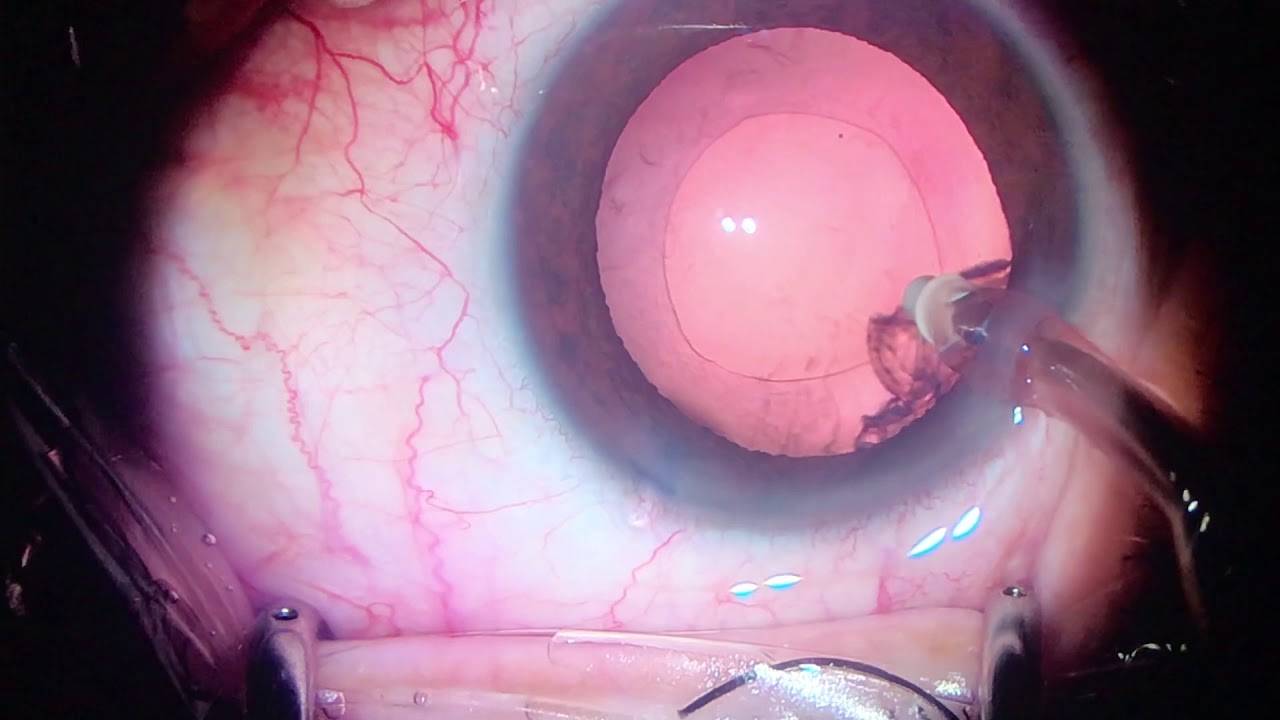 Calculo De Lente Intraocular Cirugía de catarata con lente intraocular torico, calculado con sistema