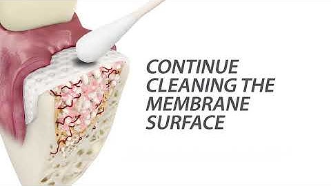 The Cytoplast™ Technique for Ridge Preservation