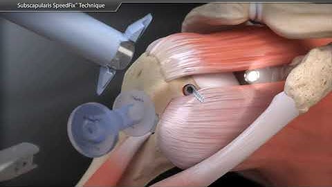 Subscapularis repair
