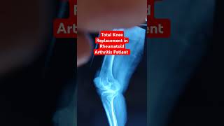 Total Knee Replacement in Rheumatoid Arthritis Patient ..#drsaichandra