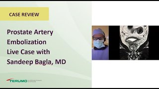Prostate Artery Embolization Live Case with Sandeep Bagla, MD | Terumo Interventional Systems