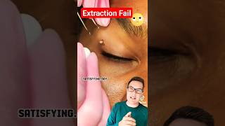 BLACKHEAD REMOVAL FAIL - Blackheads Around Eye shorts