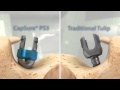Spine Wave: CapSure® PS3 Spine System