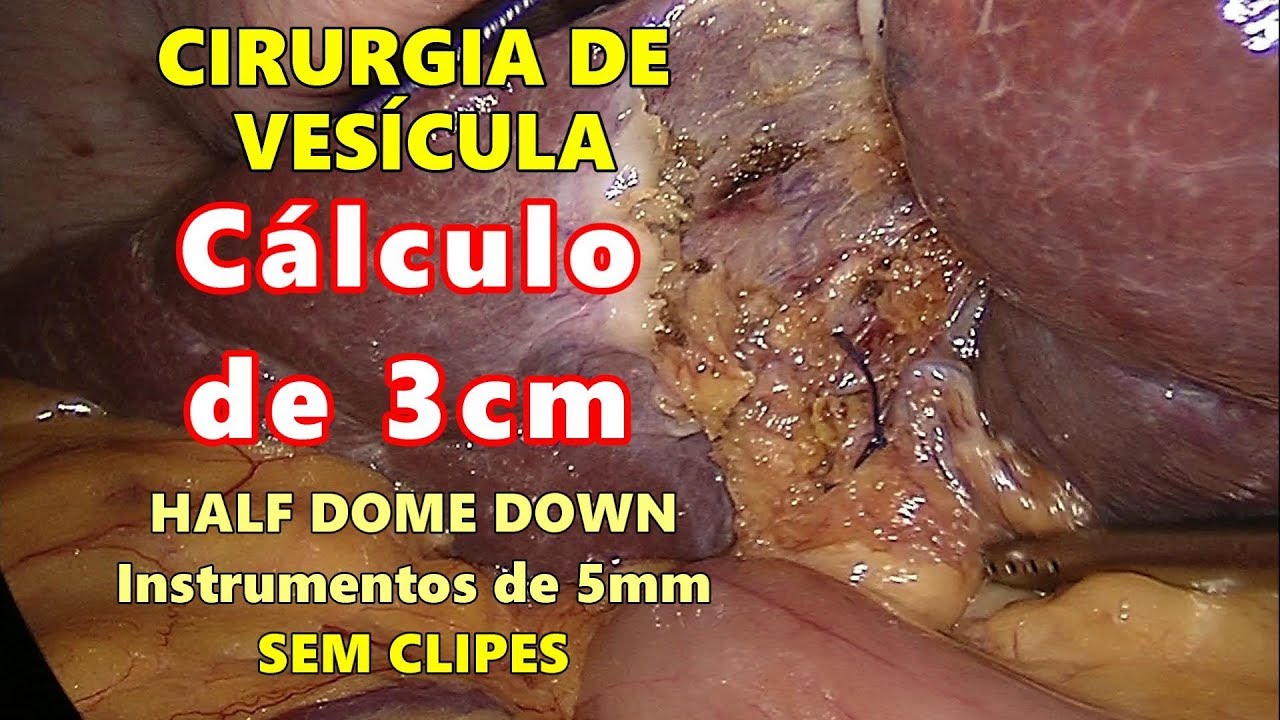 Cirurgia De Fimose Quanto Tempo Dura Cirurgia para Cálculos de Vesícula Completa Sem Clipes - Agosto 2019