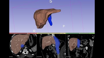 Organ segmentation 4.1 : Liver and inferior vena cava