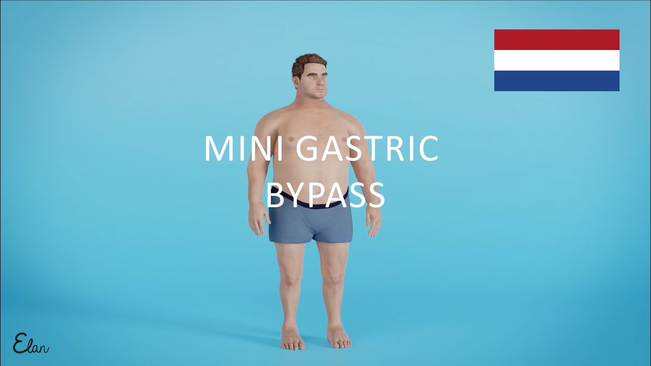 Mini Gastric Bypass animatie