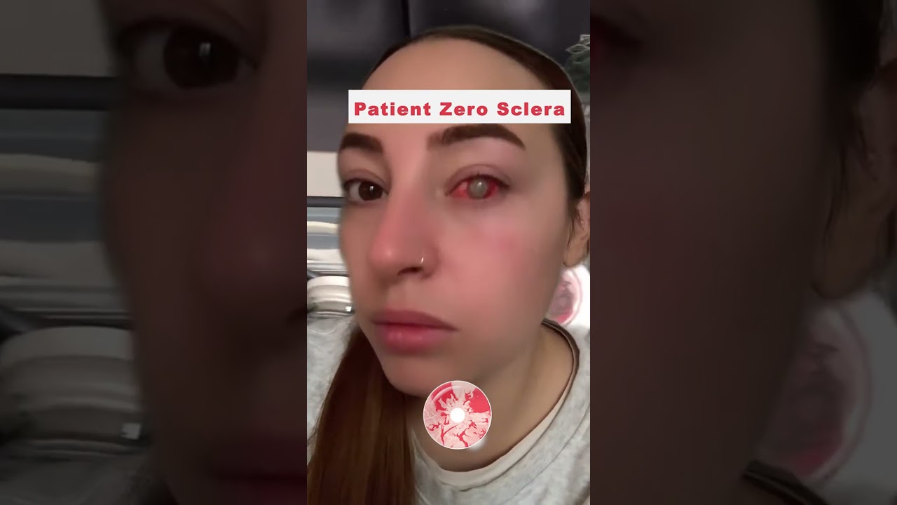 Bloody Zombie Sclera Contacts - PsEYEche, image size:1280x720