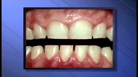 É normal a placa de bruxismo apertar os dentes?