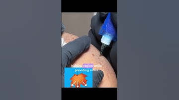 Transformation Breakdown of Two Scalp Micropigmentation Sessions | Juan Collado SMP