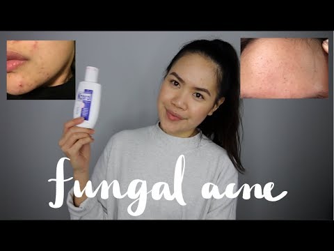 MALASSEZIA FOLLICULITIS/FUNGAL ACNE (Tiny Forehead Bumps) - My Experience and Treatment | jskavee