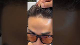 Hair Patch in BTM Layout at Just ₹6999 ✨ | Low-Price Hair Patch Solution
