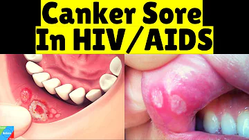 Canker Sores in HIV/AIDS | Recurrent Aphthous Ulcers in HIV/AIDS | Recurrent Aphthous Stomatitis