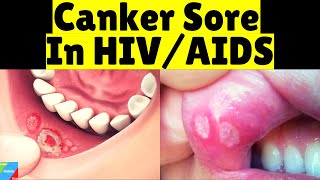 Canker Sores in HIV/AIDS | Recurrent Aphthous Ulcers in HIV/AIDS | Recurrent Aphthous Stomatitis screenshot 4