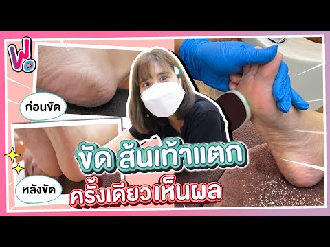 รีวิวพลีชีพ I วิธีเด็ด ! ส้นเท้าแตกขัดยังไงให้หาย คลิปนี้มีคำตอบ...