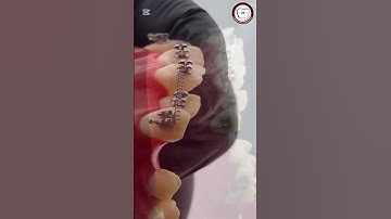 open coil placement and activation