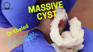 Mive Neck Cyst Removal. Dr Khaled Sadek. Lipomacyst