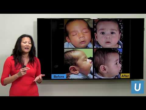 Pierre Robin Sequence | Justine Lee, MD | UCLAMDChat