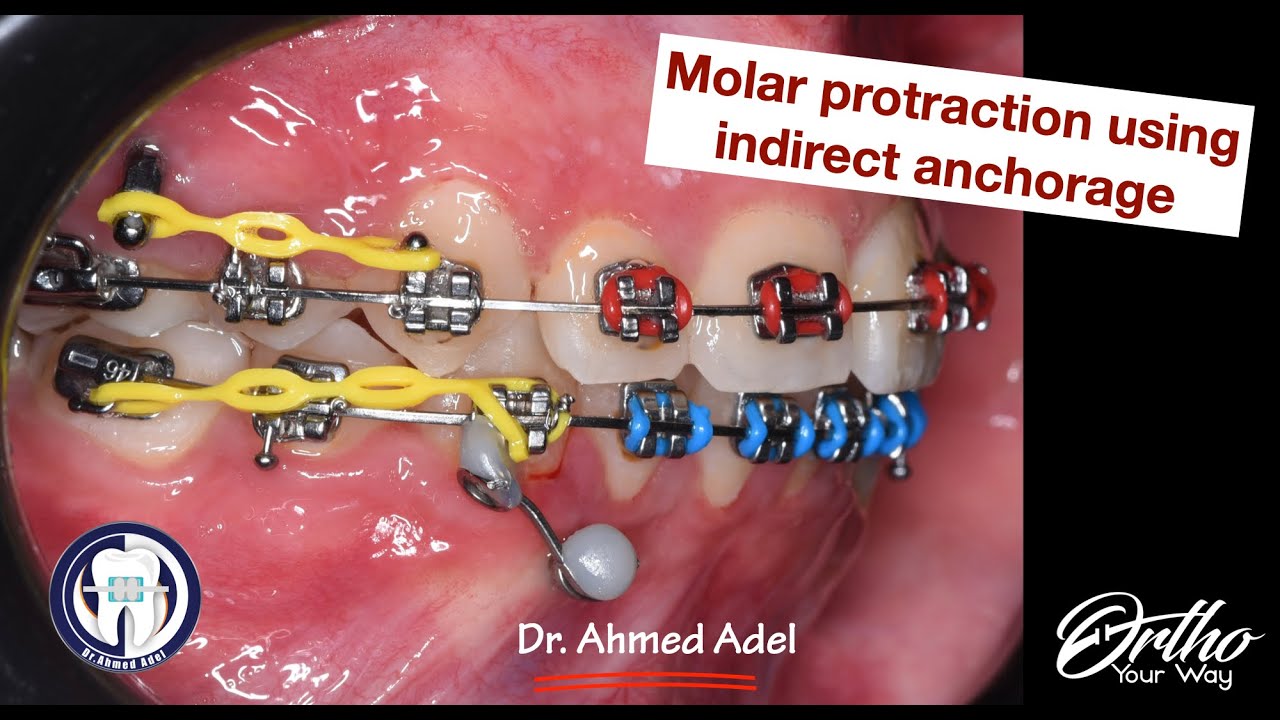 Molar protraction using miniscrew/TAD indirect anchorage step by step by dr ahmed adel