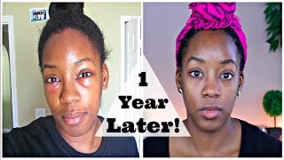 Lower Blepharoplasty Update... 1 Year Later!