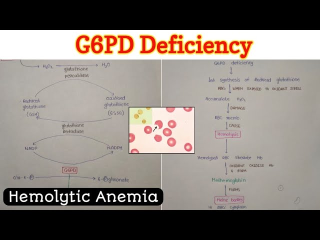 glutathione anemia Glucose 6 Phosphate Dehydrogenase (G6PD) Deficiency | Hemolytic Anemia