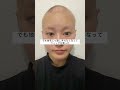 高1で髪が抜けた私の今までとこれから #カップル #脱毛症