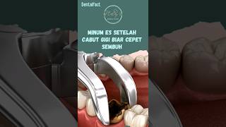 MINUM ES SETELAH CABUT GIGI BISA BIKIN CEPAT SEMBUH? #dentist #cabutgigi #doktergigi #fyp #nays